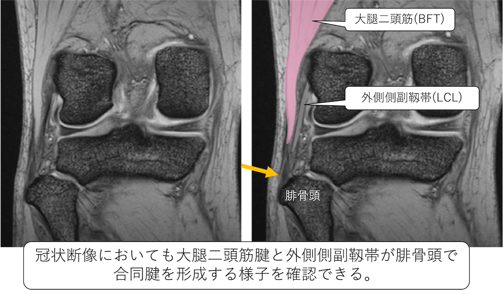 外側側副靱帯を含む膝の外側支持組織(後外側の支持組織(posterolateral 